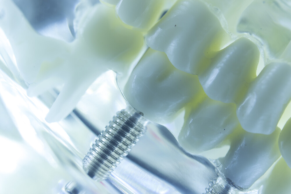 Close-up of dental implant restoration for missing tooth replacement