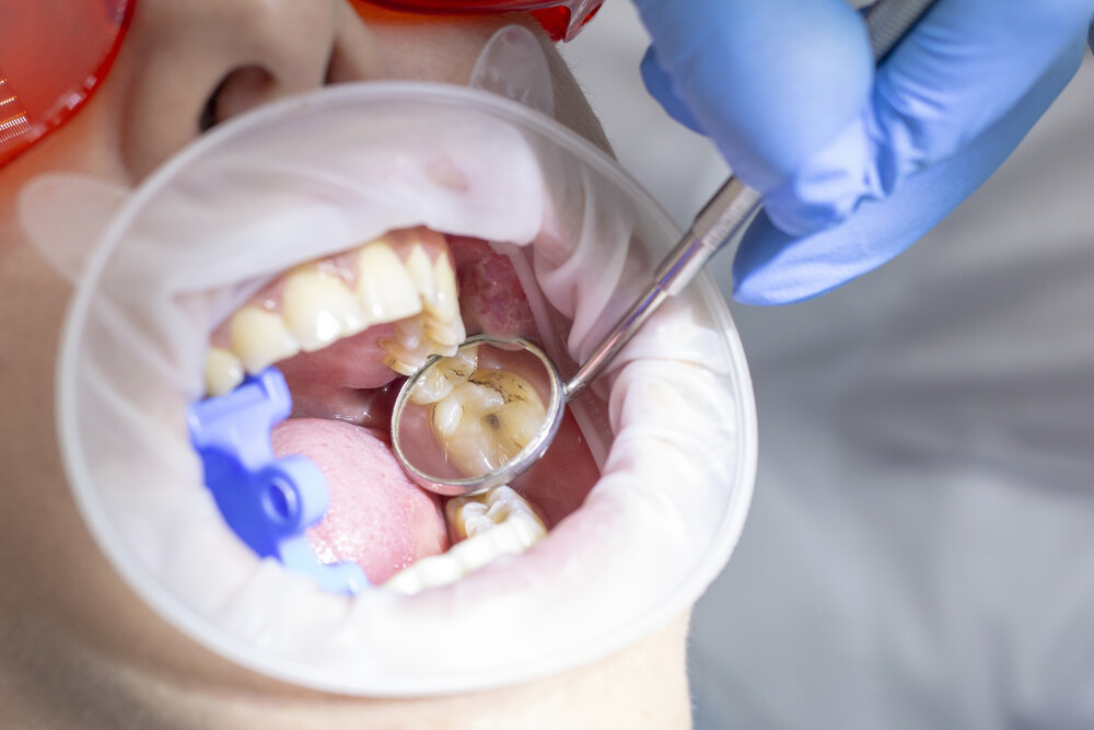 preventive examination at the dentist. caries in the tooth on the top of the girl. tooth with tooth decay visible in the dental mirror