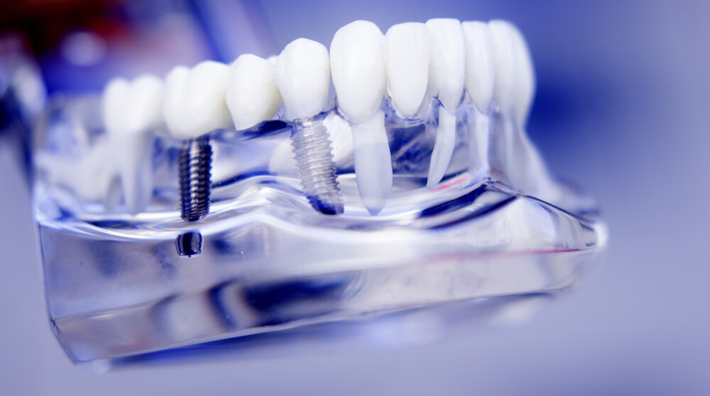 Dentists tooth plastic model with screw implant for teaching, learning and patients in dental office showing teeth and gums.