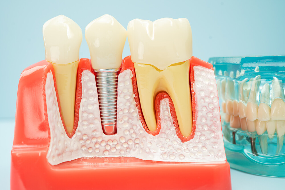 Artificial tooth roots dental implant into jaw, Root canal model for dentist.