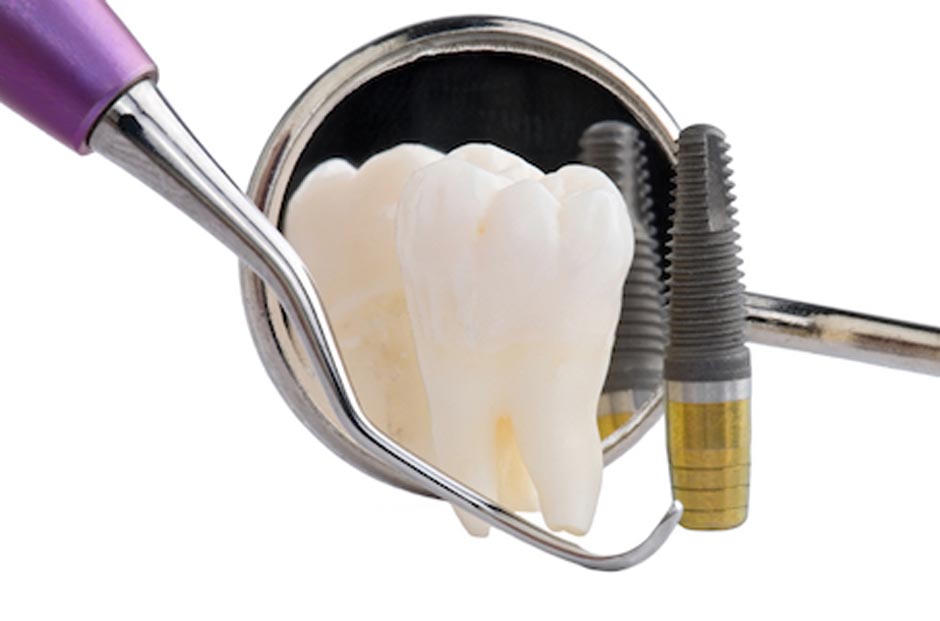 Dental implant restoration model with implant and crown components